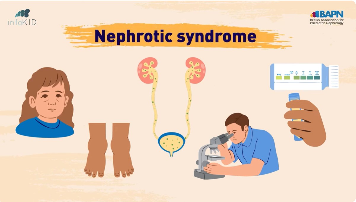 Video Preview for Nephrotic Syndrome